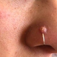 Grano en piercing de la nariz