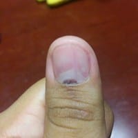 ¿Cómo saber si tengo una Eritroquinia Longitudinal?