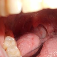 Sensación de tener algo dentro de la nariz y amígdala izquierda inflamada.