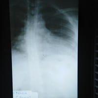 ¿Alguien puede decirme el grado de corvatura que tiene mi columna? Me detectaron escoliosis leve
