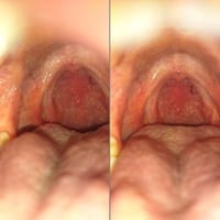Siento algo atorado en la garganta, faringitis o vph?