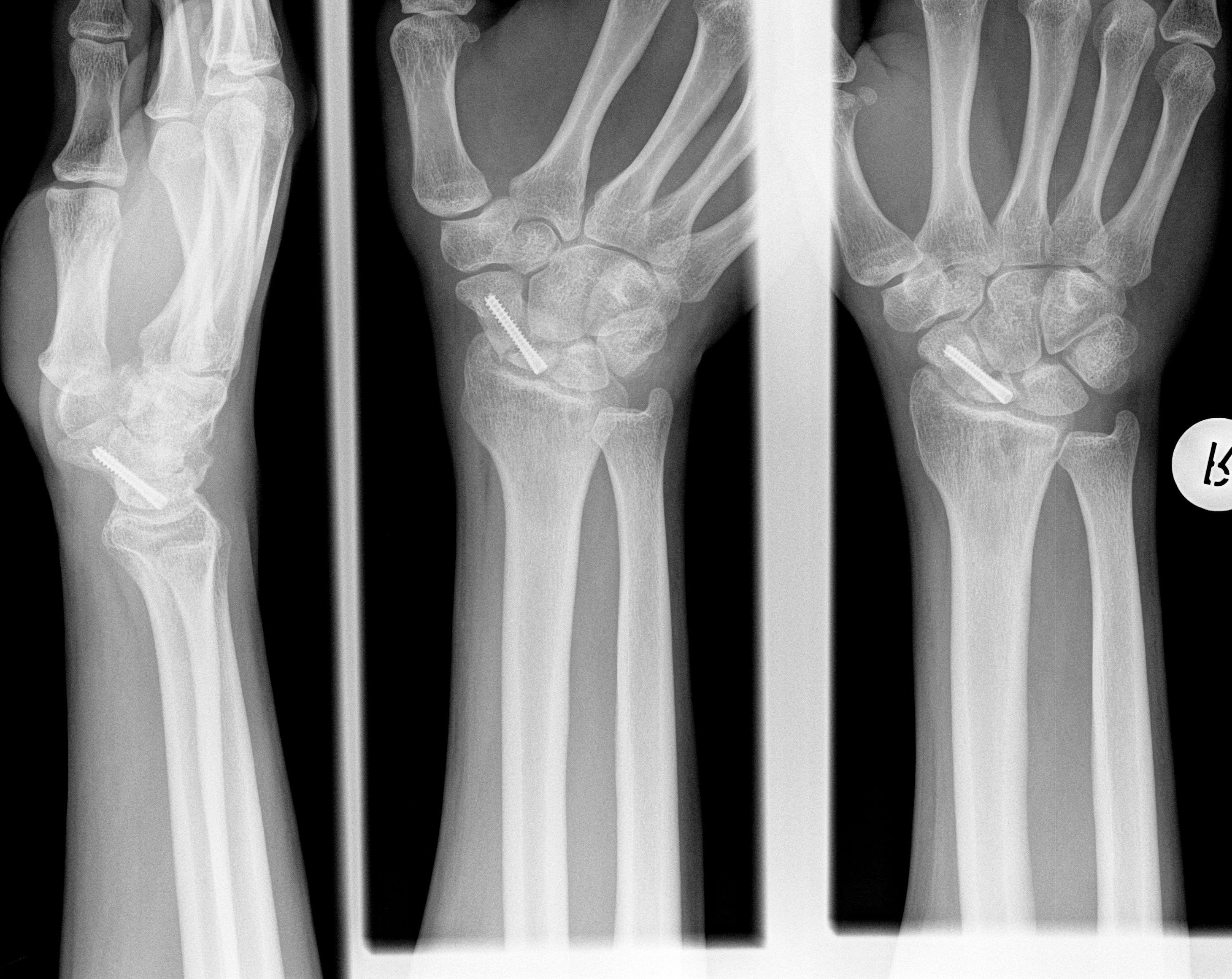 Quería saber, cuál es tu opinión de esta radiografía de una fractura de