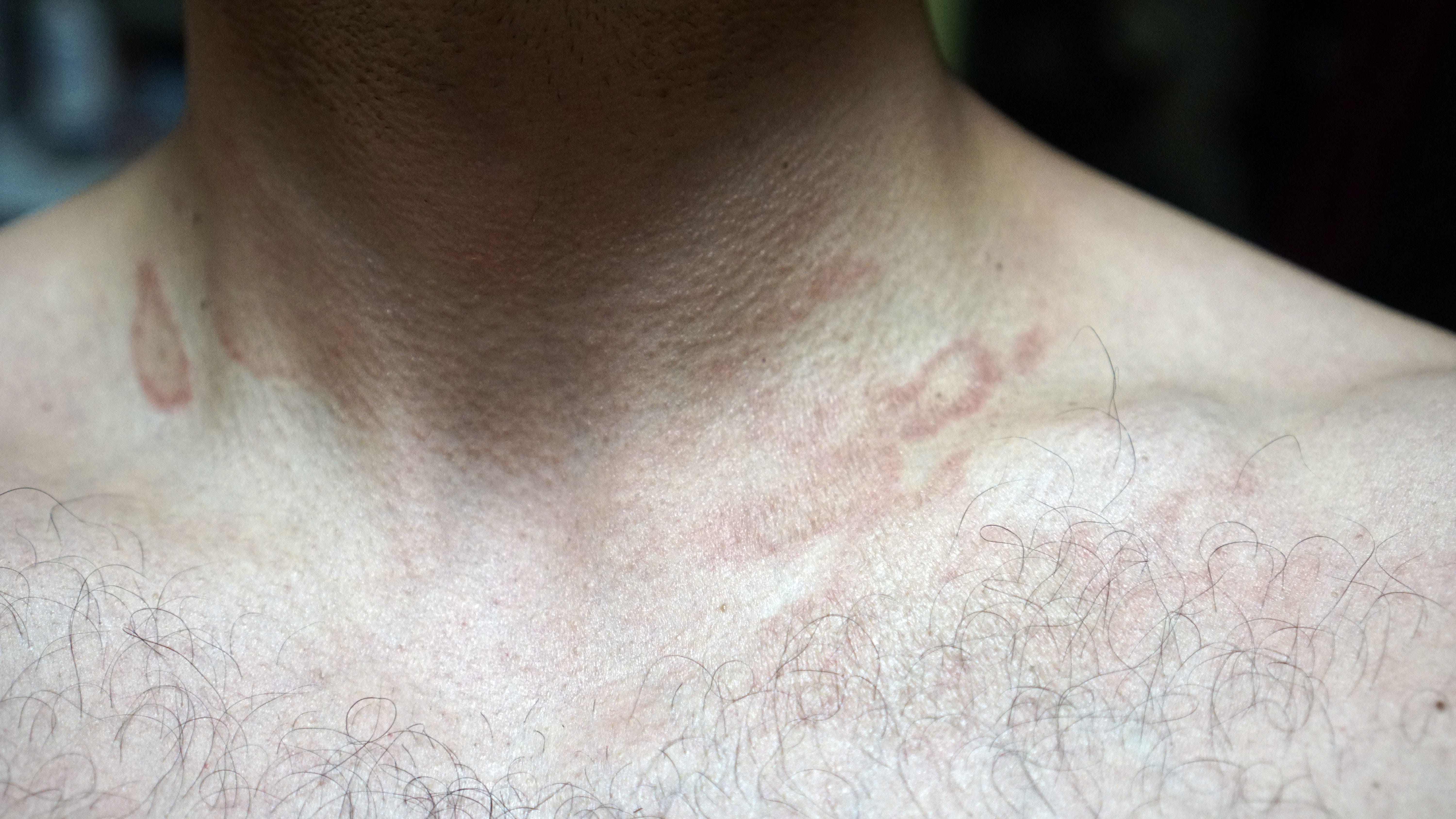 Manchas rojas en el cuello (como chupón) - Dermatología - Todoexpertos.com