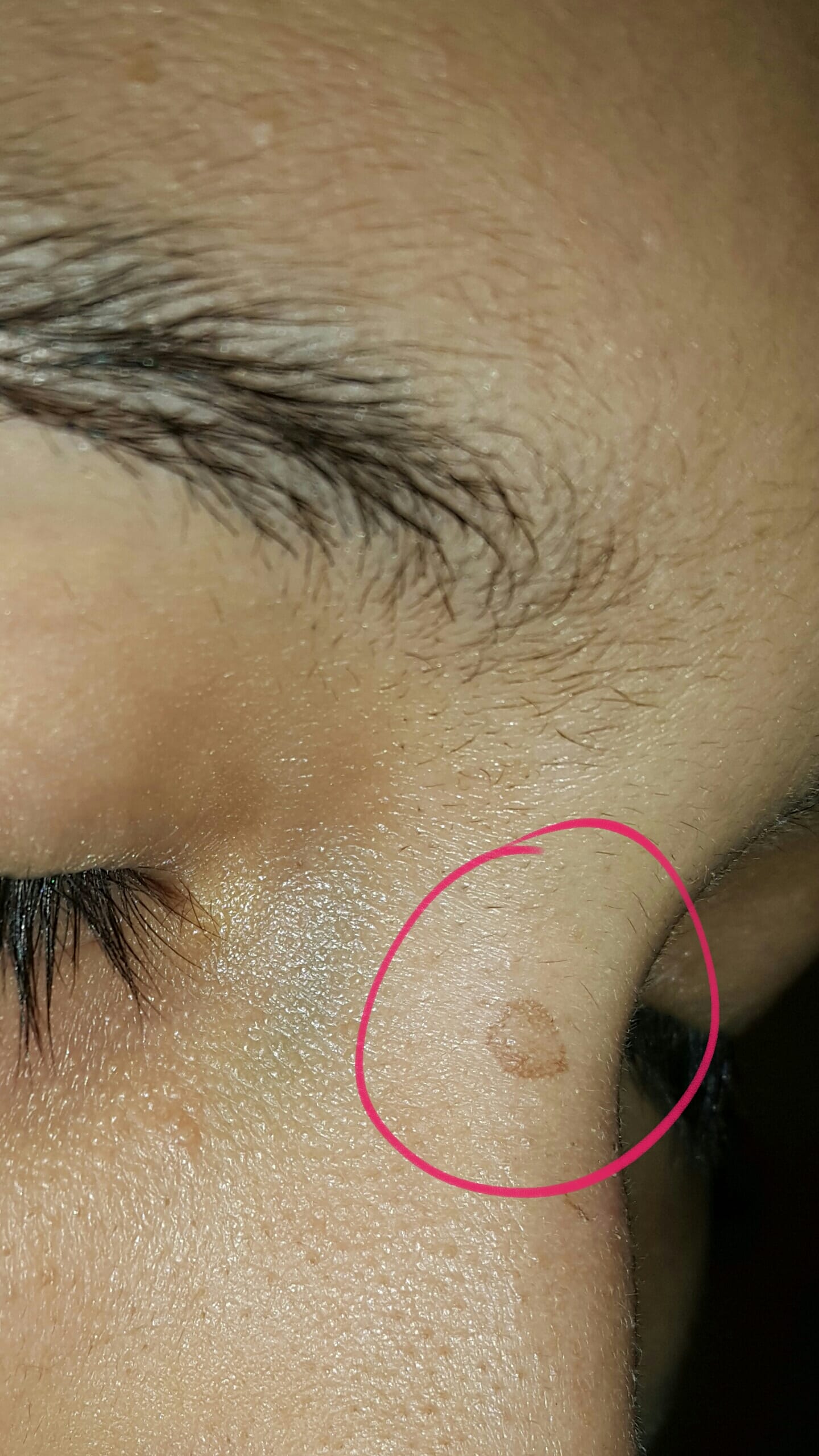 Mancha café extraña en la cara Dermatología