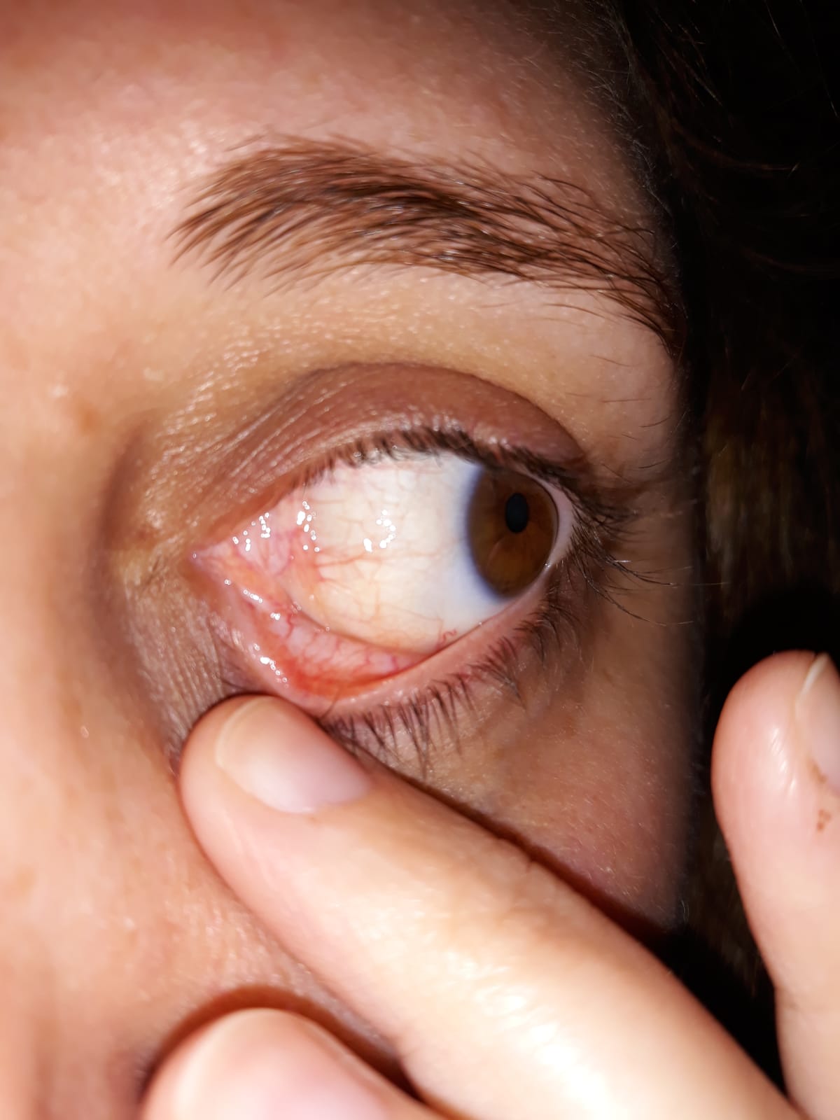 Cuerpo extraño en el ojo con dolor e inflamación. - Medicina