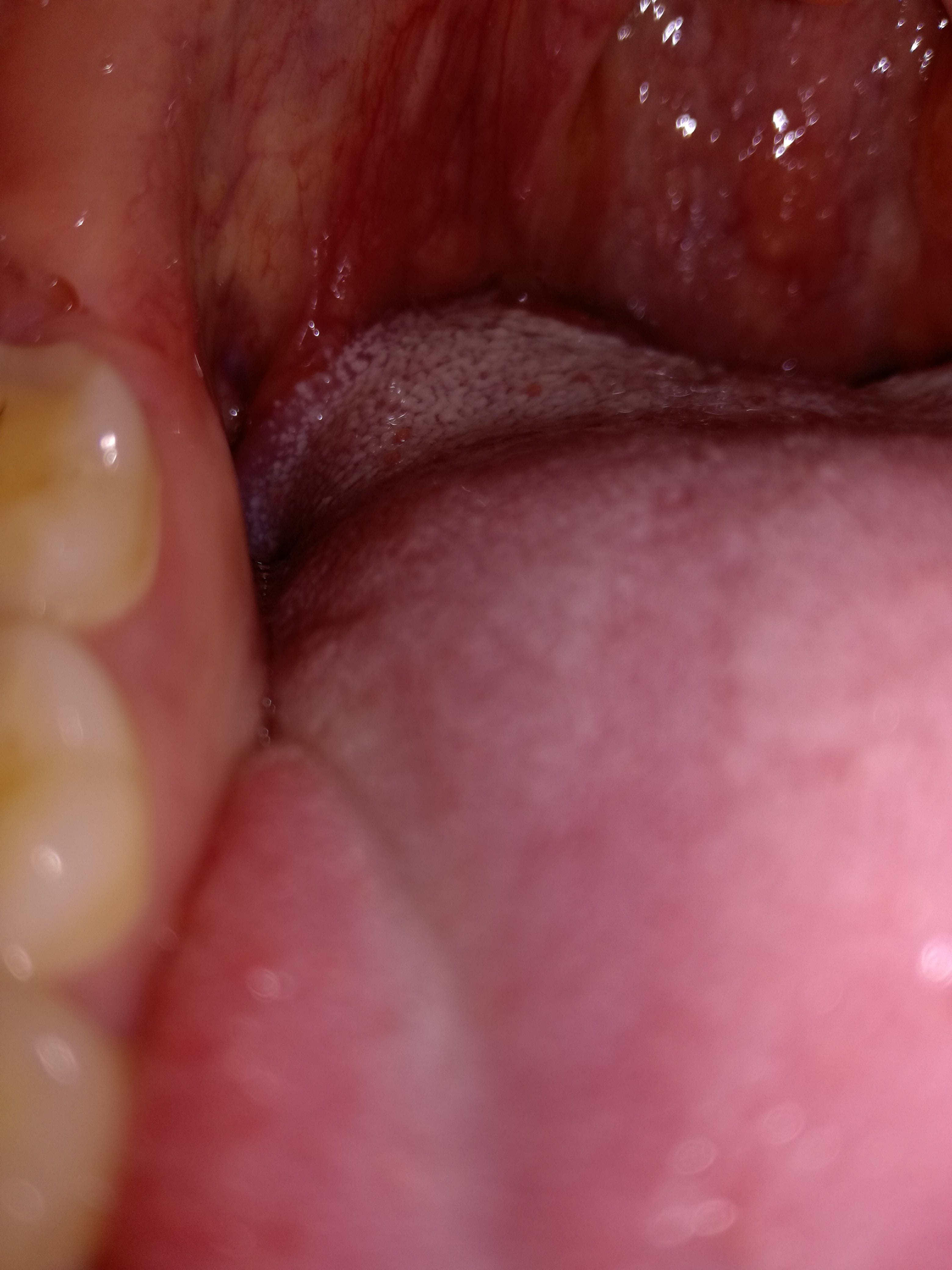 Placa blanca en garganta y final lengua duradera - Otorrinolaringología