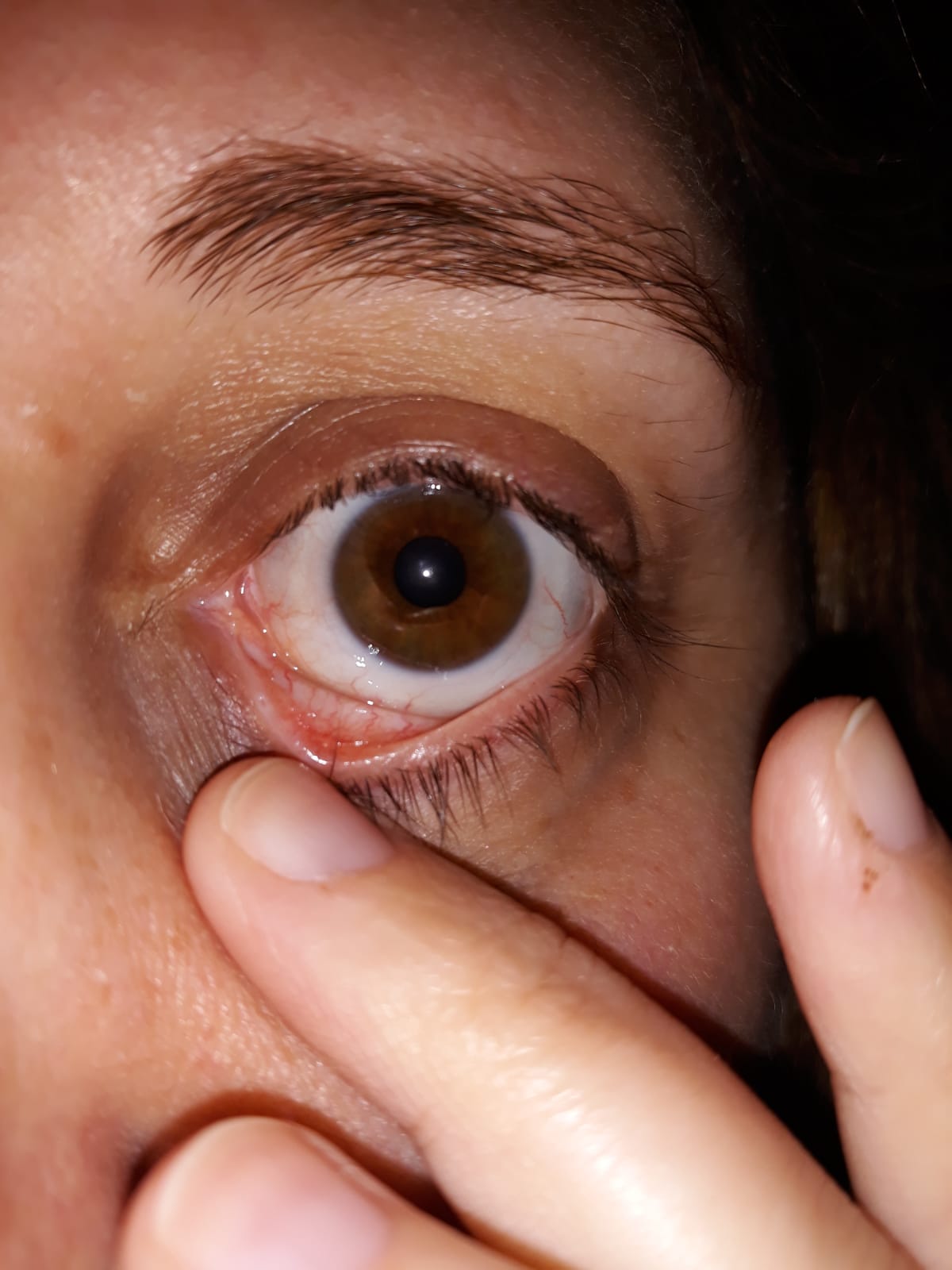 Cuerpo extraño en el ojo con dolor e inflamación. - Medicina