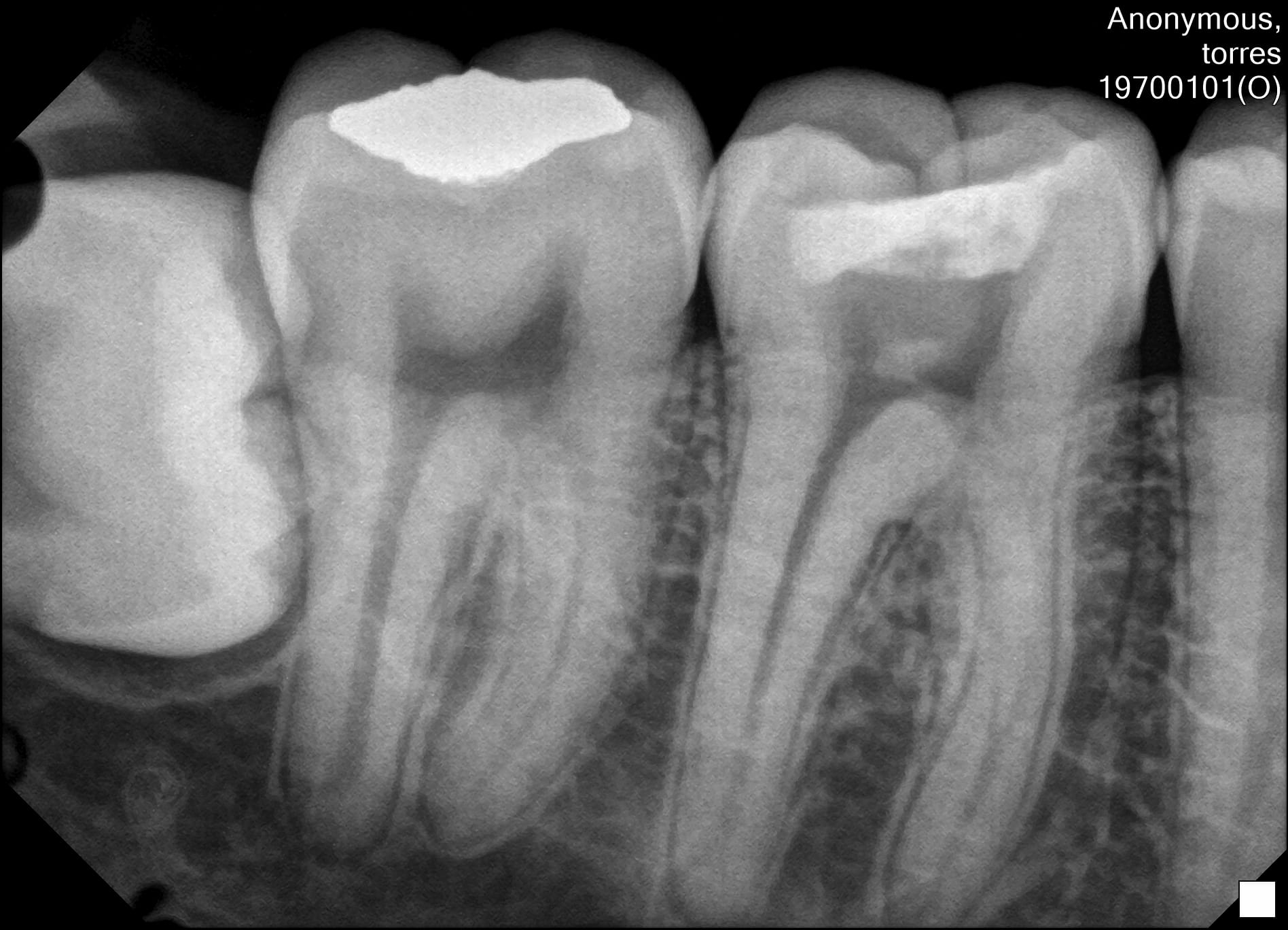 ¿Cuáles son las complicaciones de la muela del juicio? - Salud dental