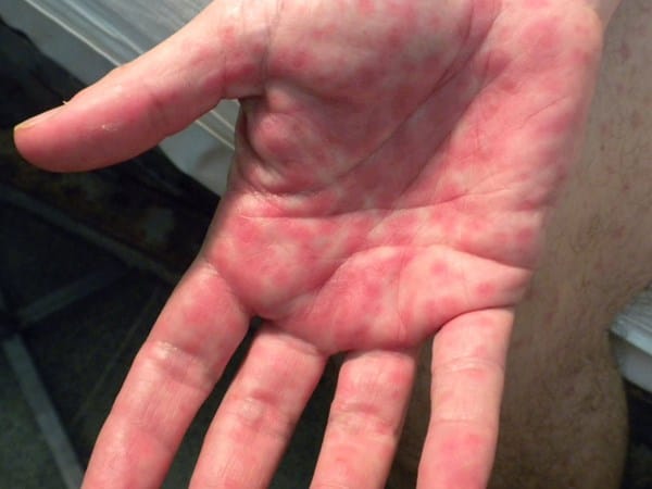Tengo puntitos rojos en las palmas las manos ah qué se debe ?. Dermatología - Todoexpertos.com