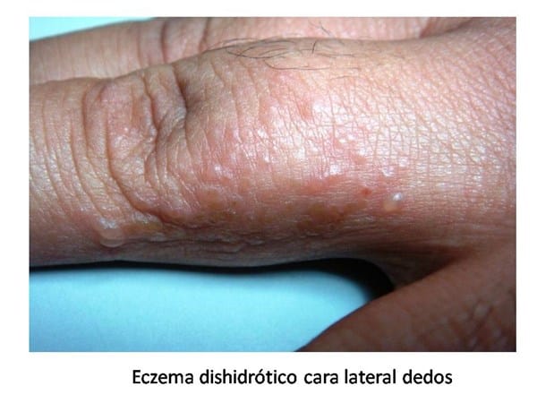 Granitos en la parte superior de mano y parte superior del pie - Dermatología - Todoexpertos.com