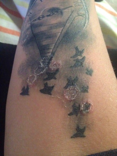 Tengo unos granos como piquetes de moscos por un tatuaje que puedo hacer an salido más - Dermatología - Todoexpertos.com